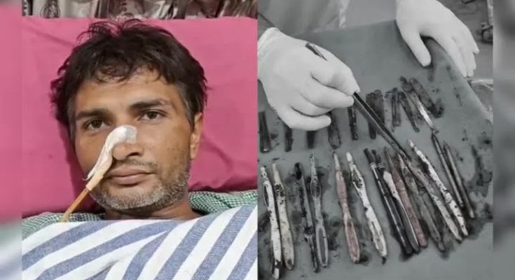 Medical Miracle: Doctors Remove 29 Spoons, 19 Toothbrushes, From 40year Man’s Stomach